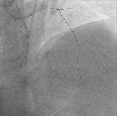 循環器内科CTO_PCI2