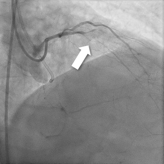 循環器内科CTO_PCI1