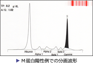 M蛋白陽性例での分画波形