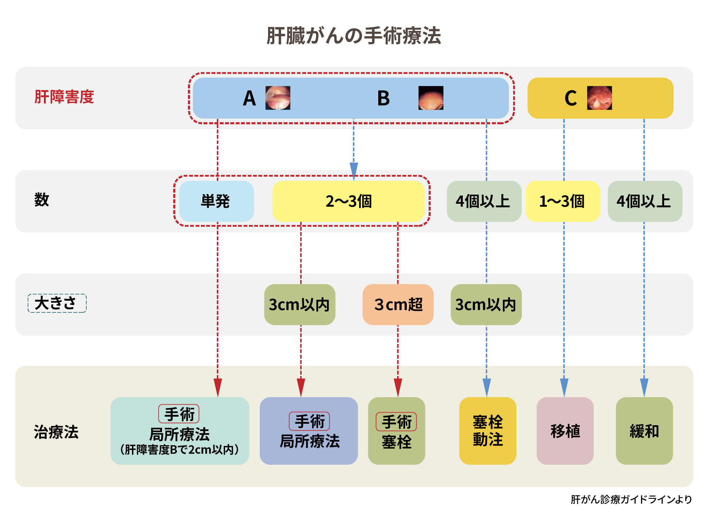 肝臓がん手術療法