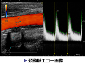 頚動脈エコー画像