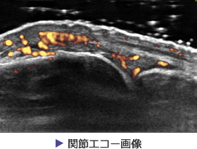 関節エコー画像